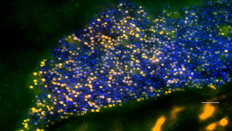 Endokartidis-Biofilm