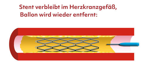 Stent verbleibt im Herzkranzgefäß, Ballon wird wieder entfernt. Jetzt ist das Gefäß wieder offen, sodass das Blut ungehindert fließen kann.