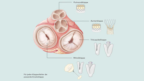 Darstellung von verschiedenen Herzklappen