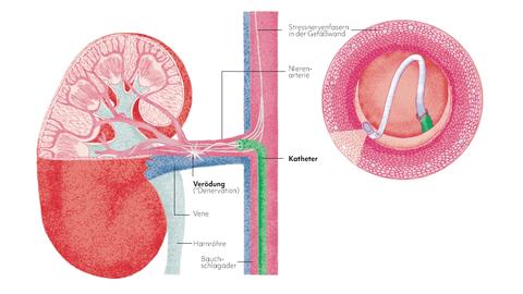 Darstellung renale Denervation